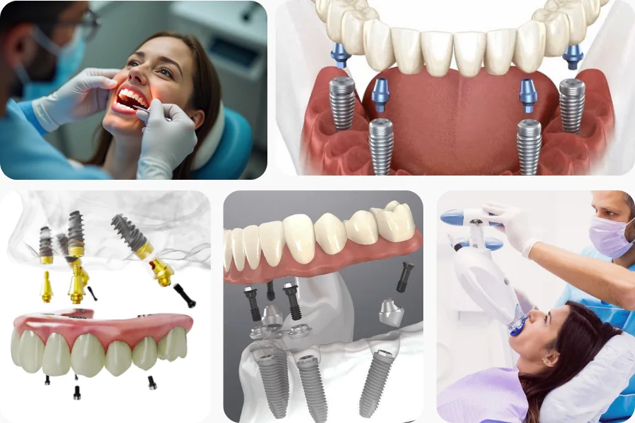 All-on-4 Dental Implants
