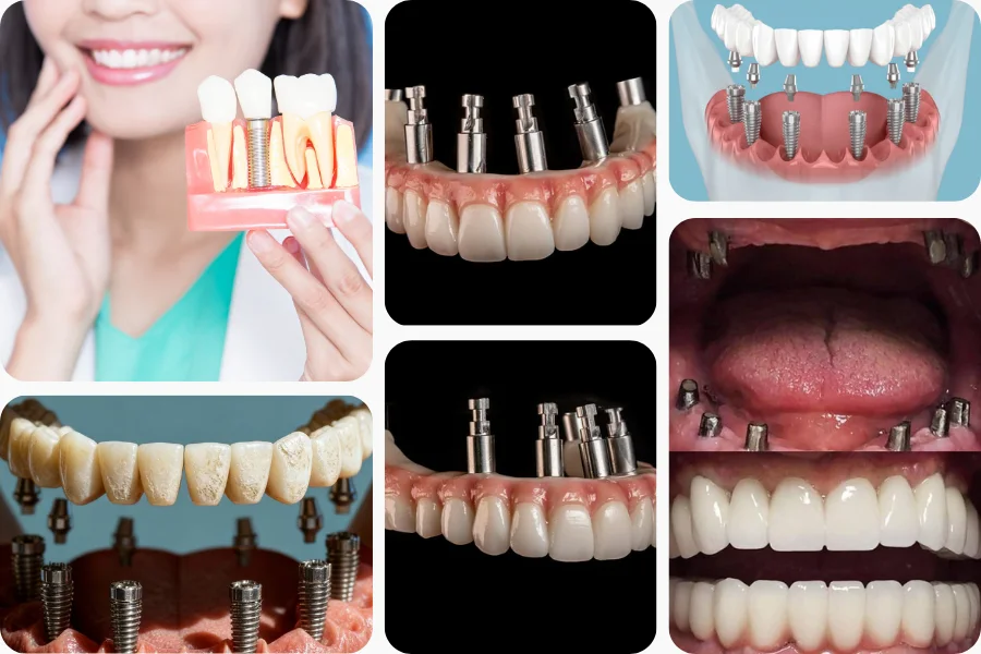 All-on-6 Dental Implants
