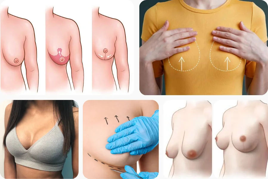 Breast Lift