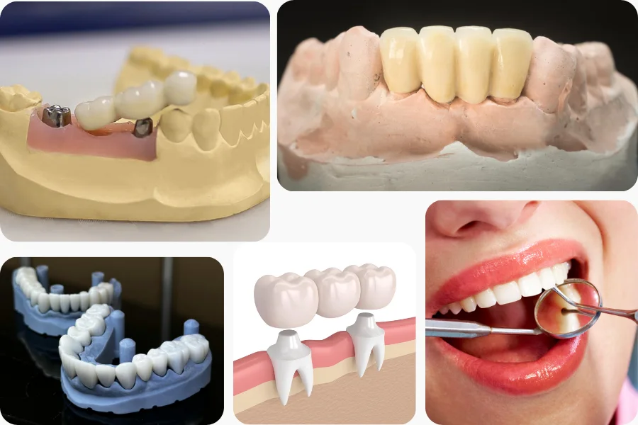 Dental Bridges