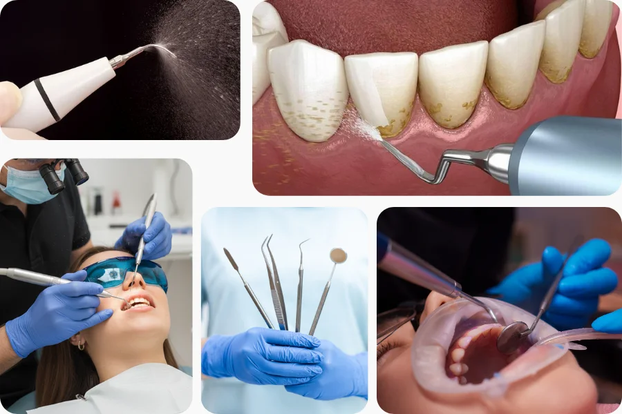 Dental Scaling (Tartar Removal)