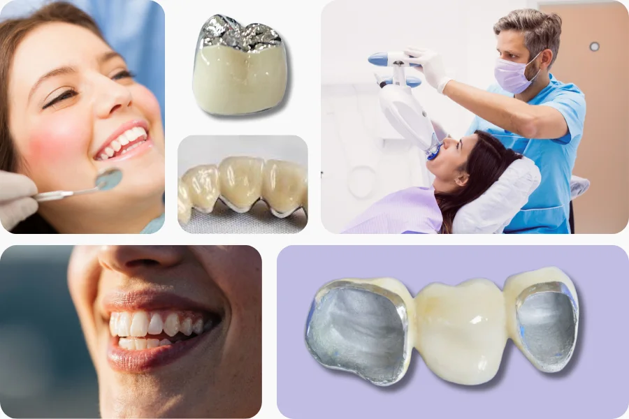 PFM Crown (Porcelain-Fused-to-Metal)