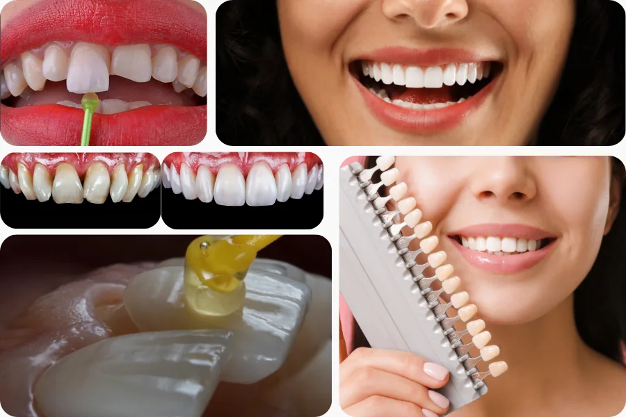 Porcelain Laminate Veneer