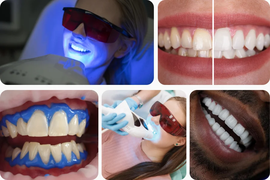 Professional Teeth Whitening