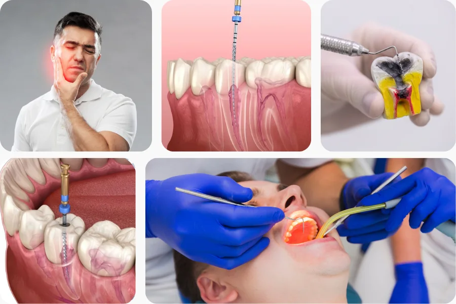 Root Canal Treatment