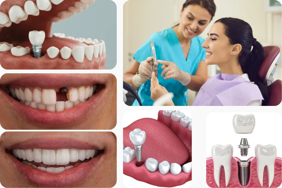 Single Dental Implant