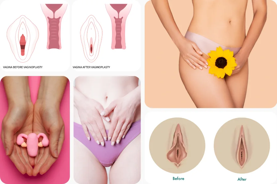 Vaginoplasty