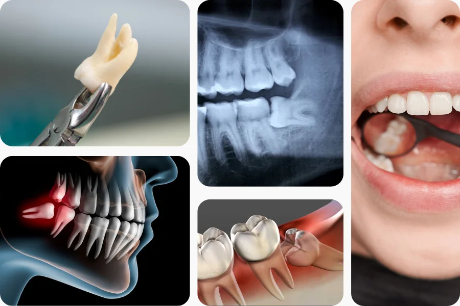 Wisdom Tooth Extraction