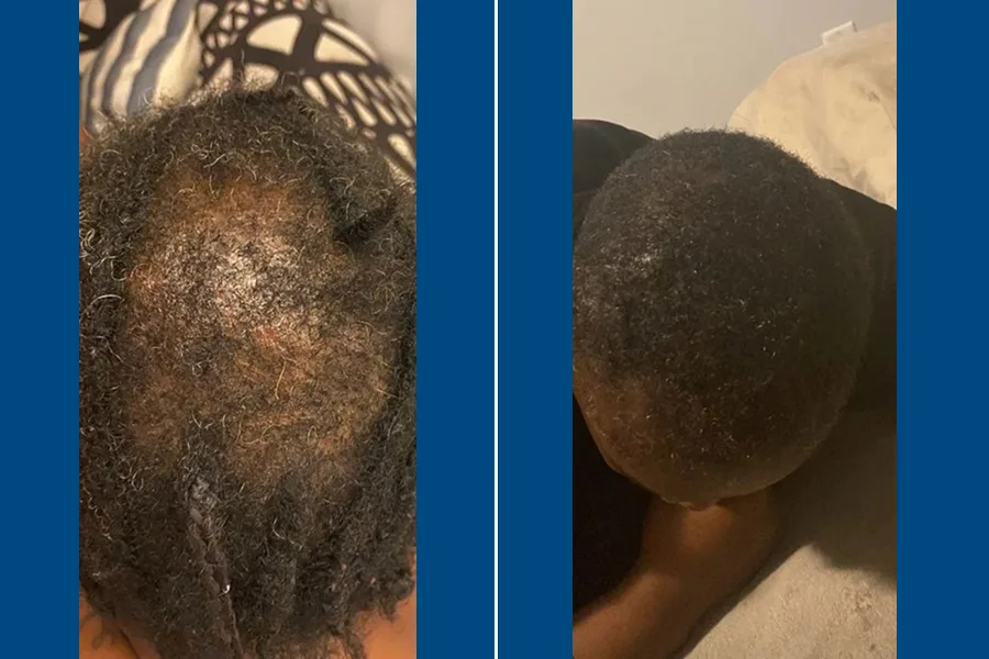 Afro-Hair FUE Transplantation: Embrace Your Roots