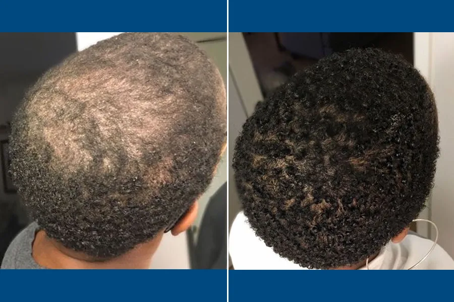 Afro-Hair FUE Transplantation: Embrace Your Roots