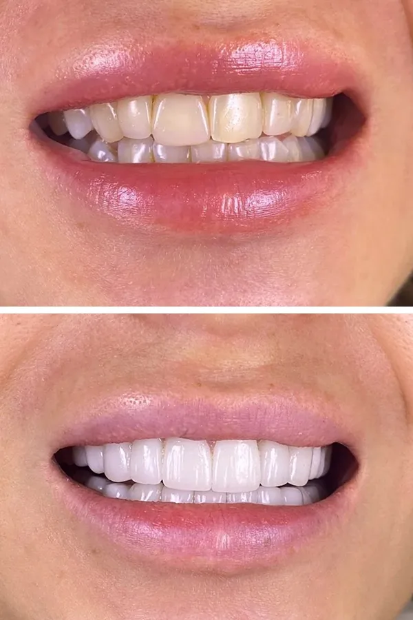 All Dental Alanya case