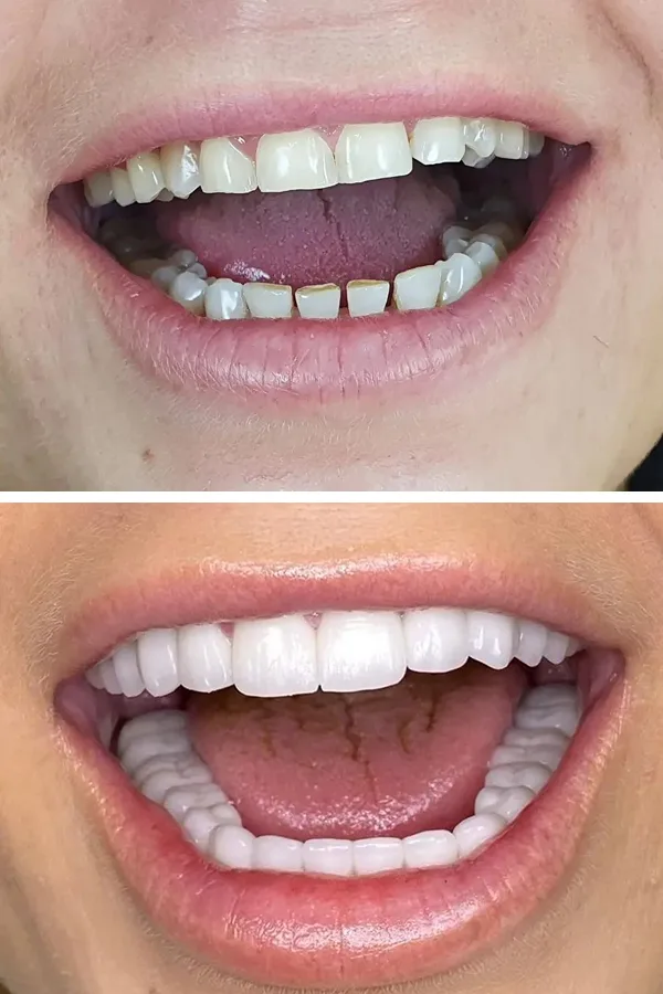 All Dental Alanya case