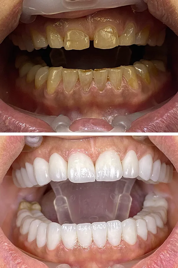 All Dental Alanya case