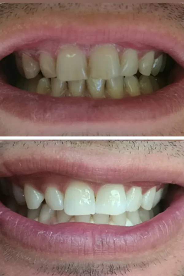 All Dental Alanya case