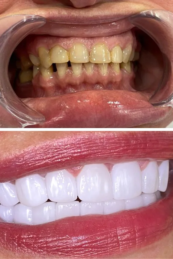 All Dental Alanya case