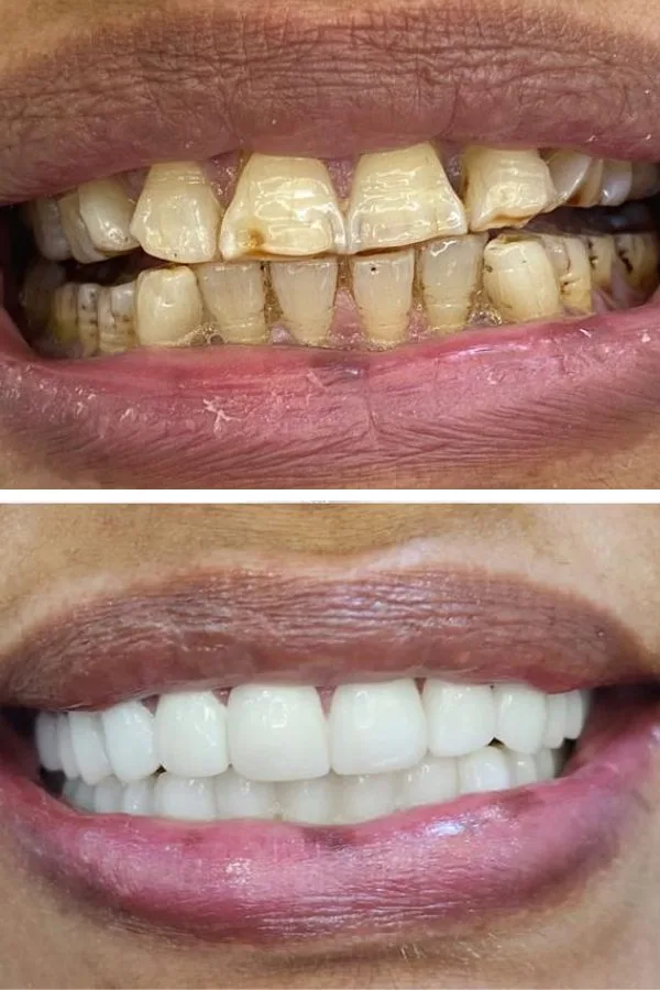 All Dental Alanya case