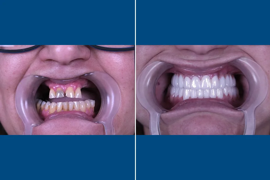 All-on-4 Dental Implants