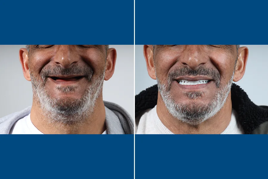 All-on-4 Dental Implants