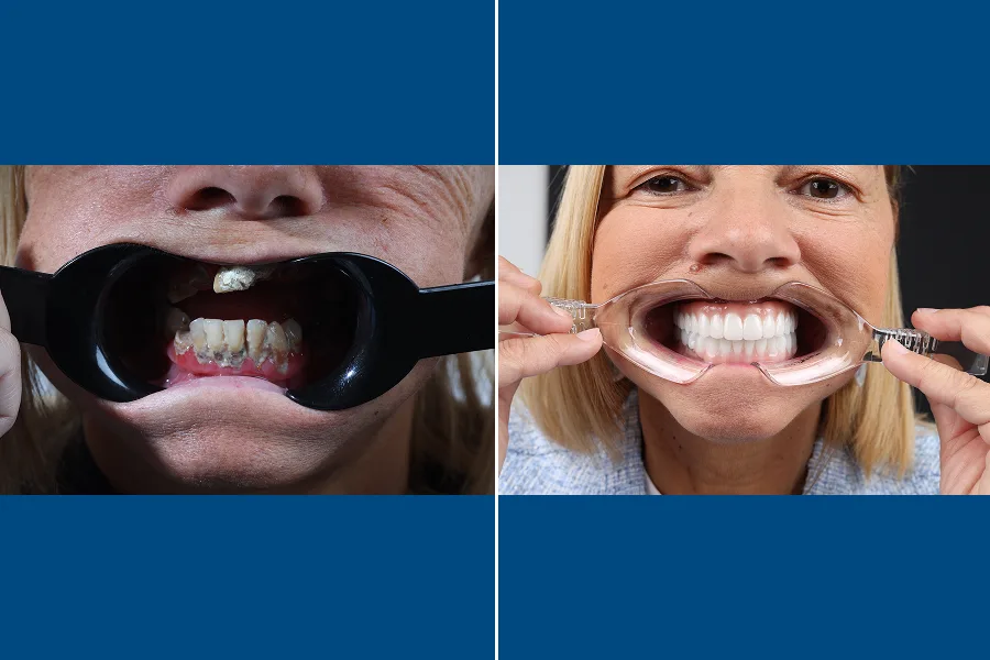 All-on-4 Dental Implants