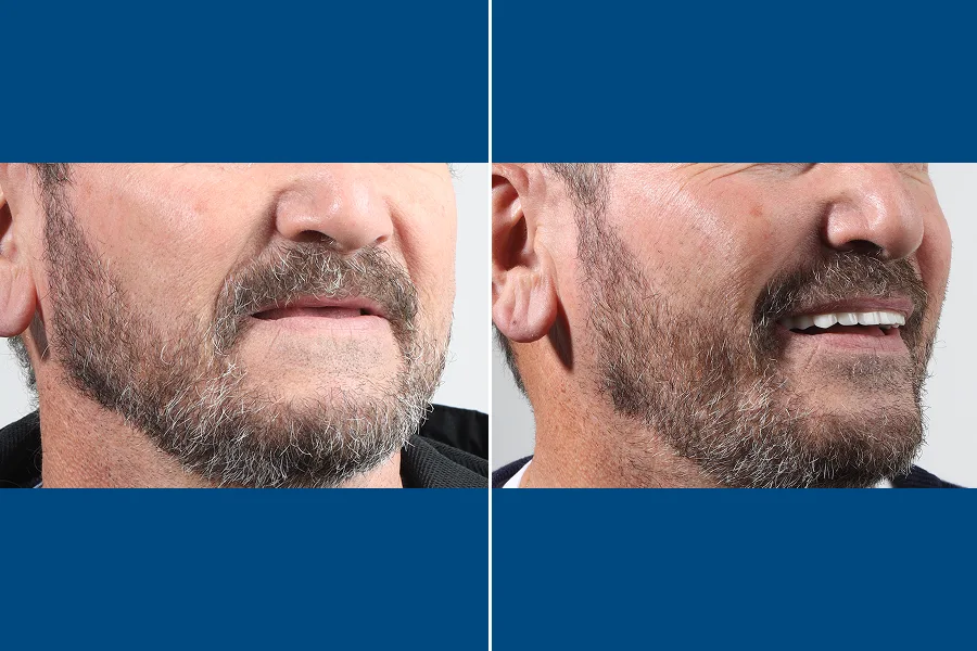 All-on-6 Dental Implants