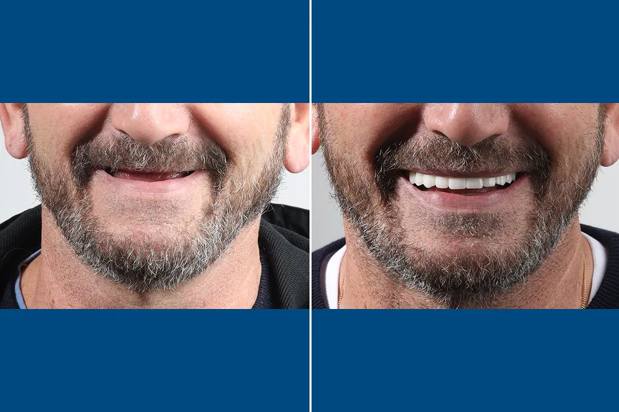 All-on-6 Dental Implants