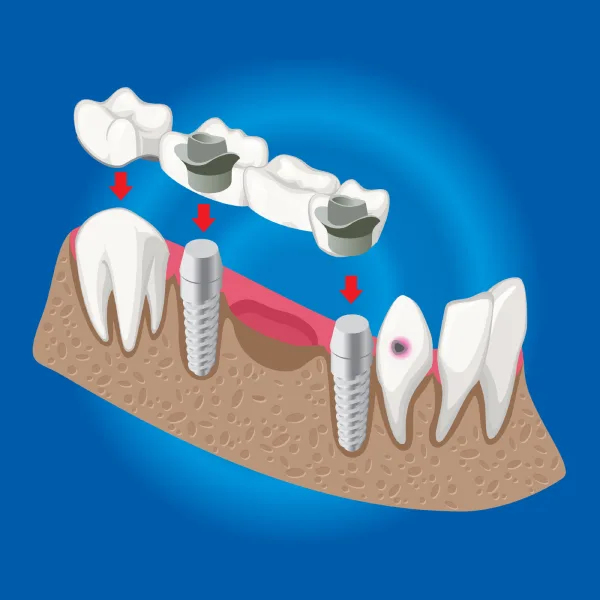All-on-6 Dental Implants