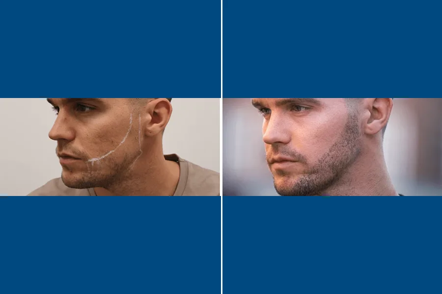 Beard Transplantation: Frame Your Face