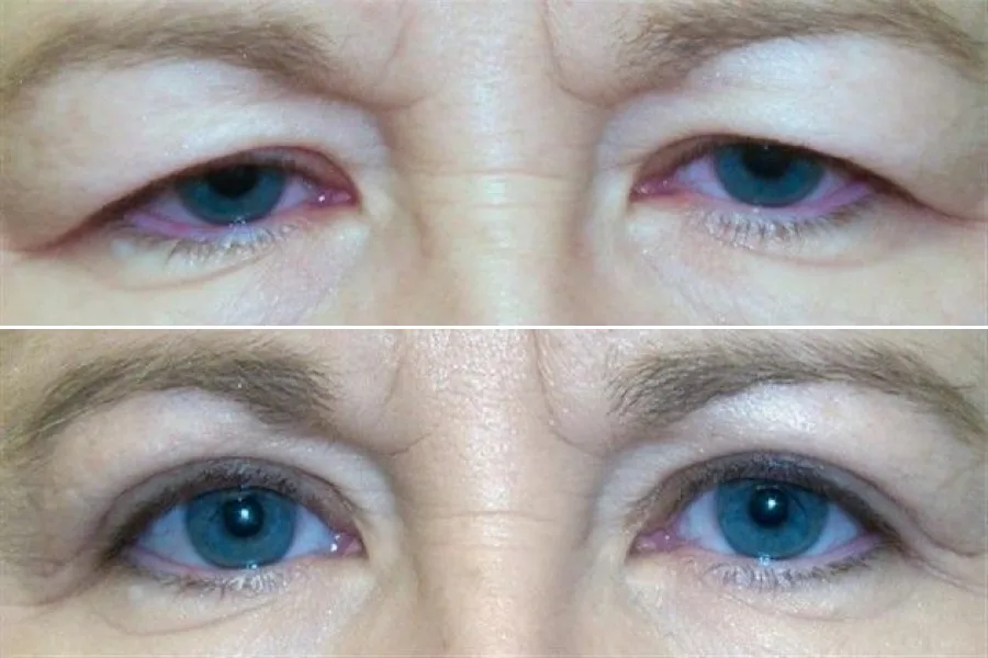 Blepharoplasty