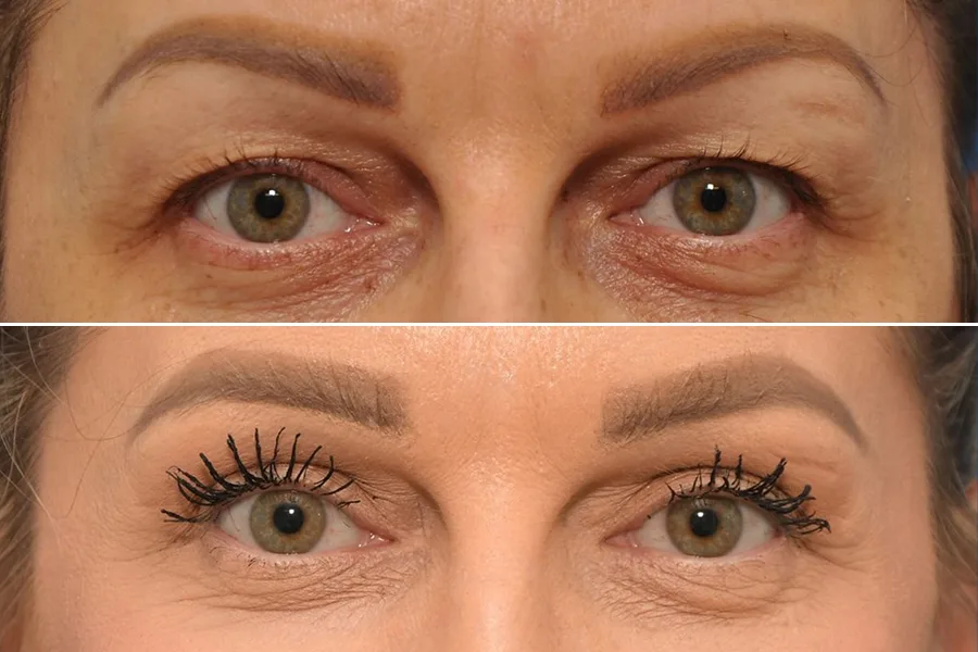 Blepharoplasty