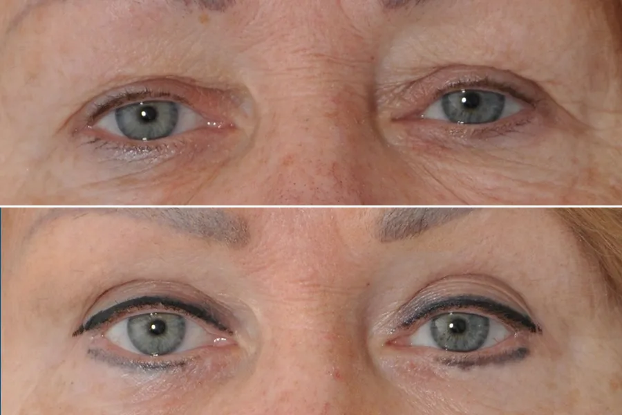 Blepharoplasty