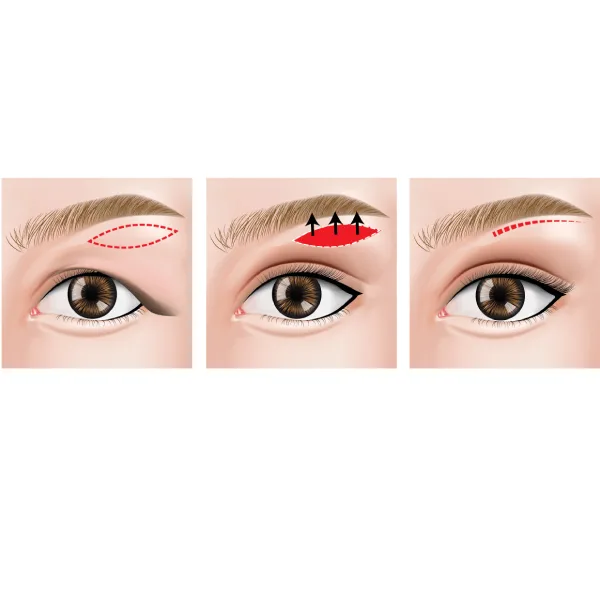 Blepharoplasty