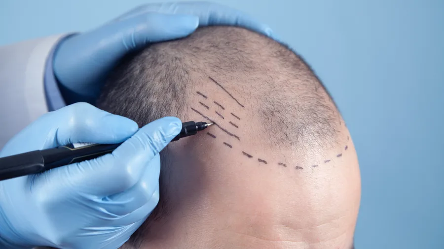 Трансплантация волос на теле: Преобразите свой образ page background