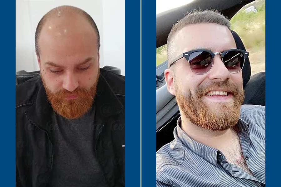 Body Hair Transplantation: Redefine Your Look