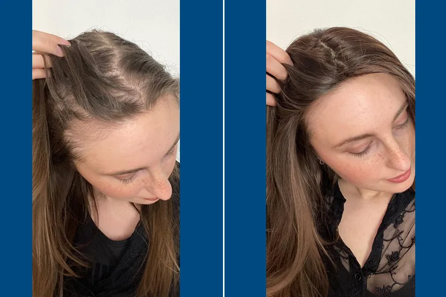 Body Hair Transplantation: Redefine Your Look