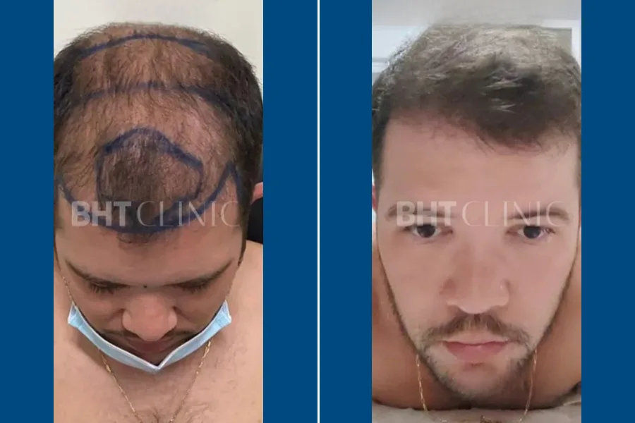 Body Hair Transplantation: Redefine Your Look