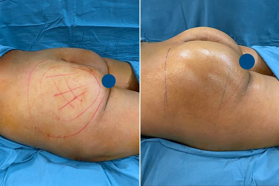 Brazilian Butt Lift (BBL)