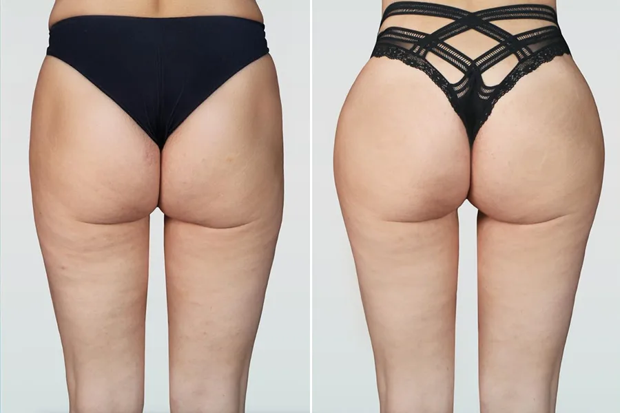 Brazilian Butt Lift (BBL)