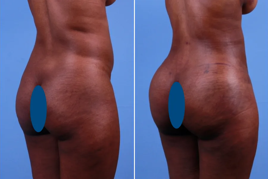 Brazilian Butt Lift (BBL)