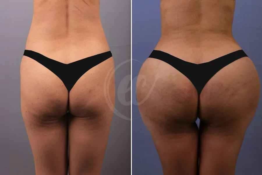 Brazilian Butt Lift (BBL)