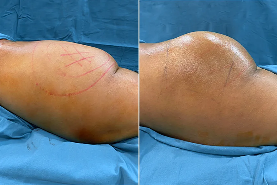 Brazilian Butt Lift (BBL)