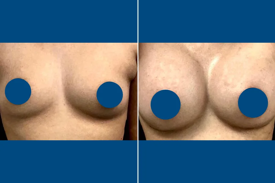 Breast Augmentation