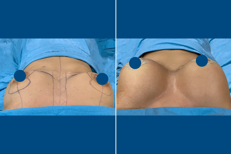 Breast Augmentation