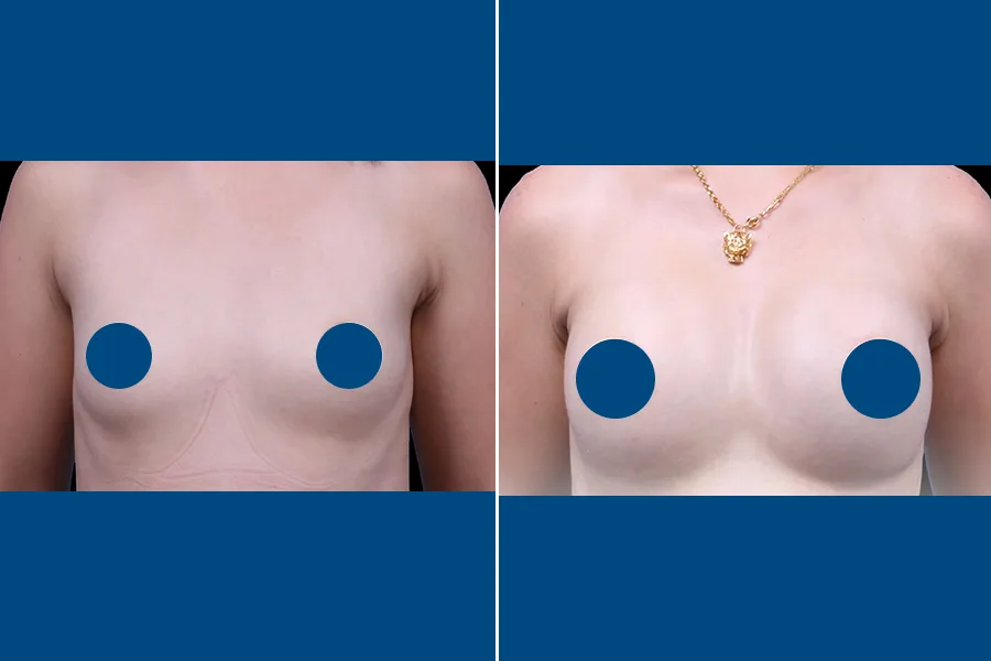 Breast Augmentation