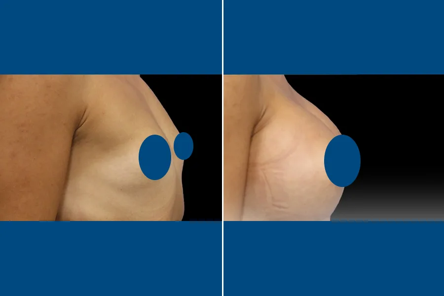 Breast Augmentation
