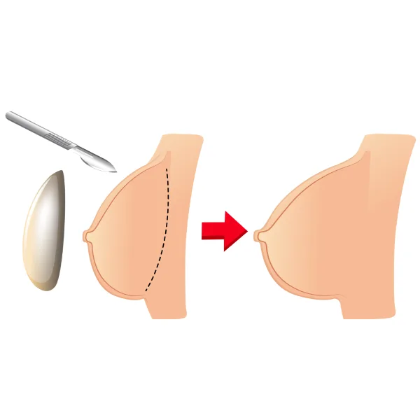 Breast Augmentation