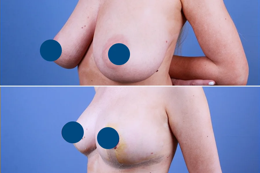 Breast Lift