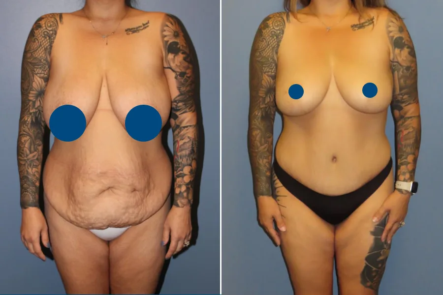 Breast Lift