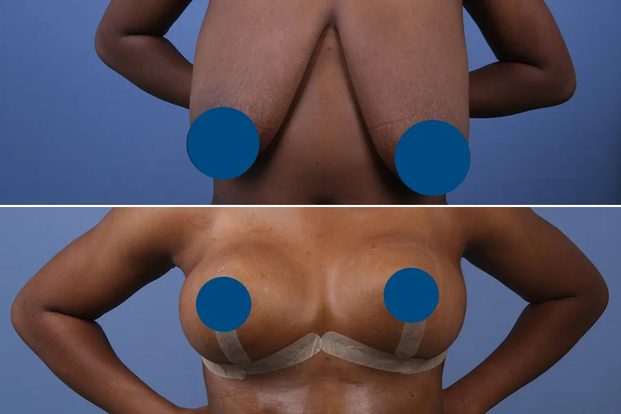 Breast Lift