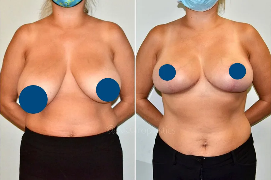 Breast Lift