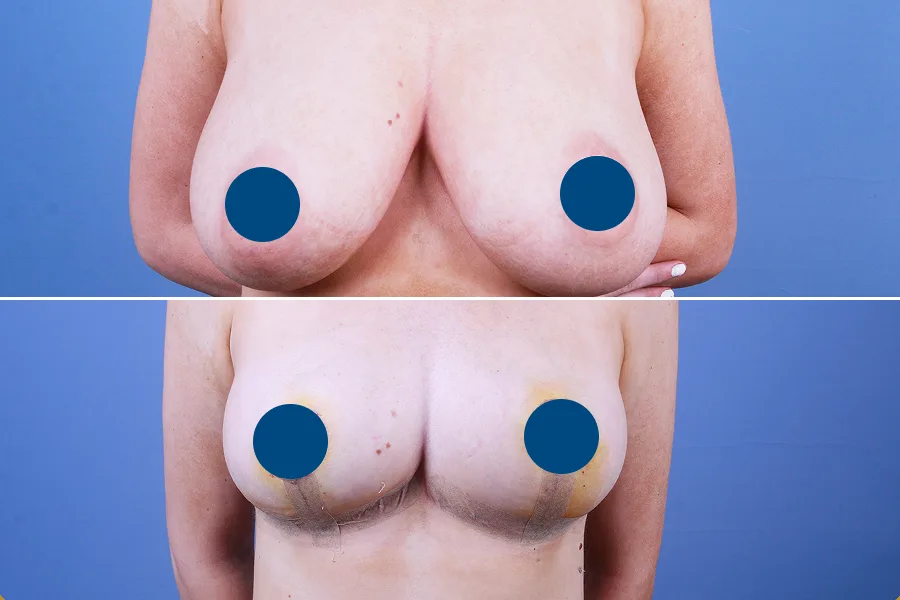 Breast Lift